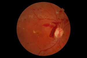 Burlington Eye Doctors Retinal Scan